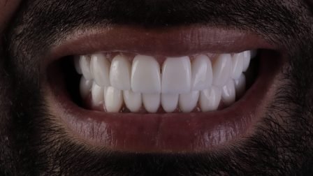 Después caso cerámico NY